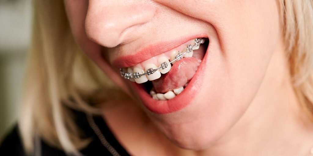 dental braces